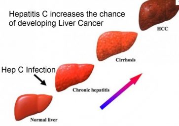 Hepatitis C Cirrhosis , Hepatitis C Treatment - Generic Hepatitis C Drugs