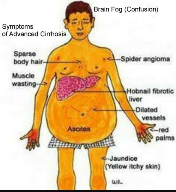 Hepatitis C and liver failure - Hepatitis C Treatment