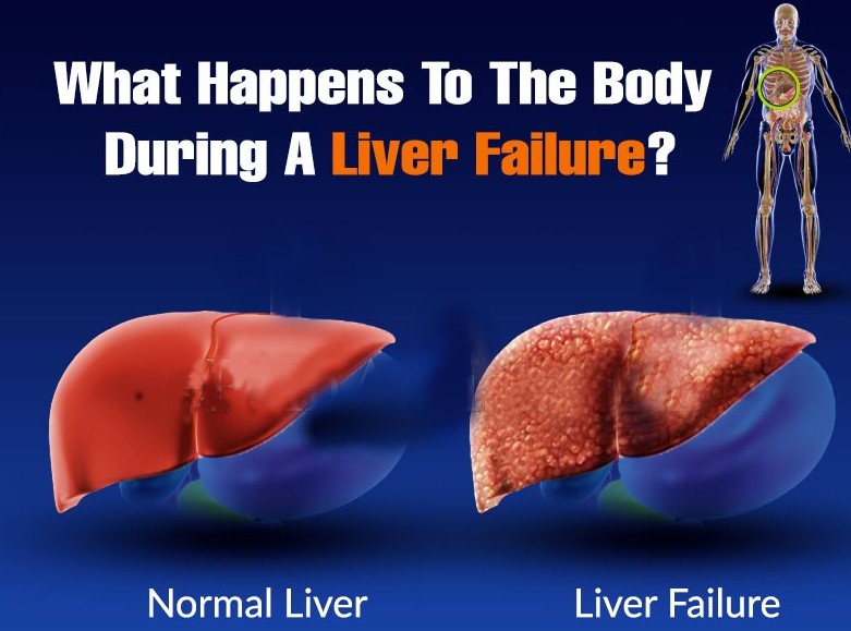 Hepatitis C and liver failure - Hepatitis C Treatment