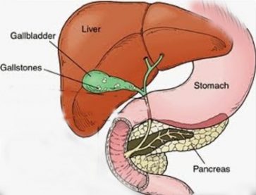 Hepatitis C And Gallstones - Hepatitis C Treatment