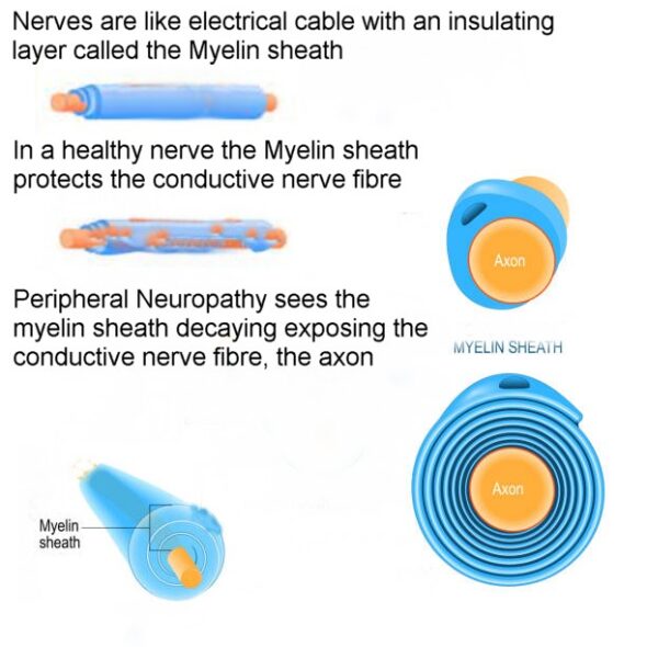 Hep C And Peripheral Neuropathy Hepatitis C Treatment 4287